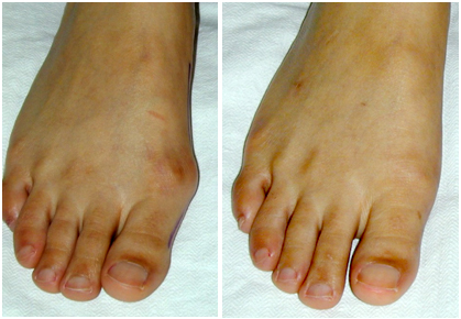 Pictures Of Before And After Of Cosmetic Foot Reconstruction Surgery 48