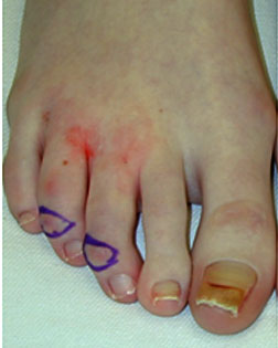 Bent toes and toe shortening
