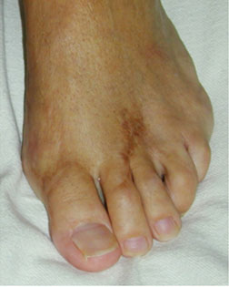 Severe toe overlap resolved with Foot Surgery Services
