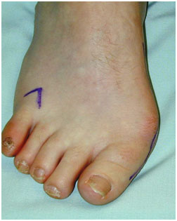 bunions fixed at Foot Surgery Services