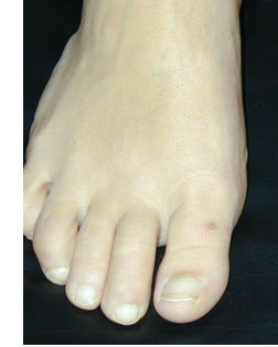 Foot Surgery Services helps another bunion sufferer