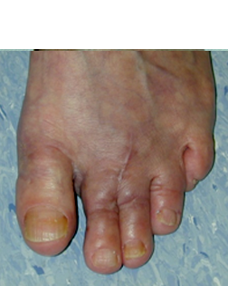 Bunion and Chilblain After Surgery ny Foot Surgery Services