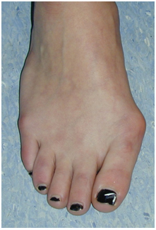 Bunion Before Surgery