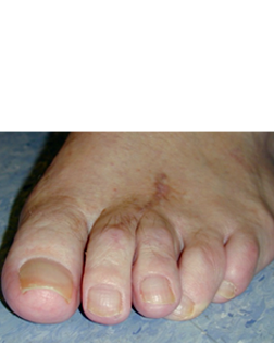 Bunion Deformity after surgery by Doot Surgery Services