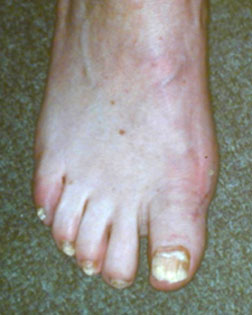 an extreme case of a bunion - after an operation by Foot Surgery Services