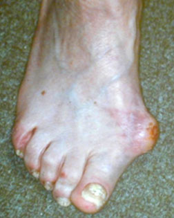 extreme bunion before