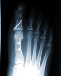 Bunon X ray after surgery by Foot Surgery Services