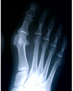 X Ray of a bunion