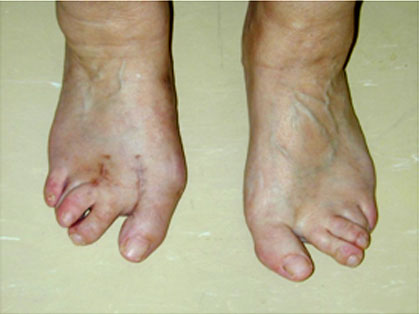 Feet still Deformed after surgery by other Surgeons