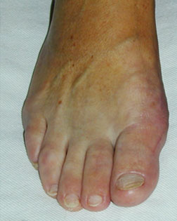 Further Corrective Foot Surgery carried out by Foot Surgery Services