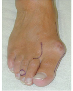 rheumatoidArthritis in the feet