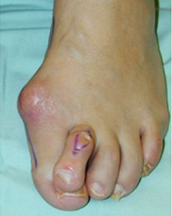 Severe toe overlaps and hammer toes