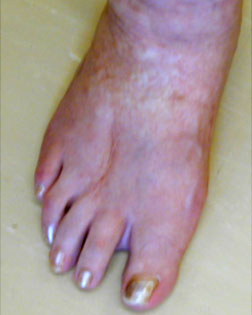Revision Surgery by Foot Surgery Services has left a normal functioning and normal looking foot